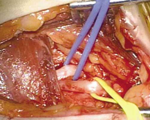 Peripheral Nerve Surgery